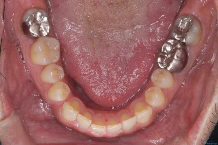 メタルフリー｜全ての銀歯をセラミックへ 治療前画像