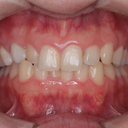 前歯のガタつきと反対咬合をインビザラインで短期矯正 治療前