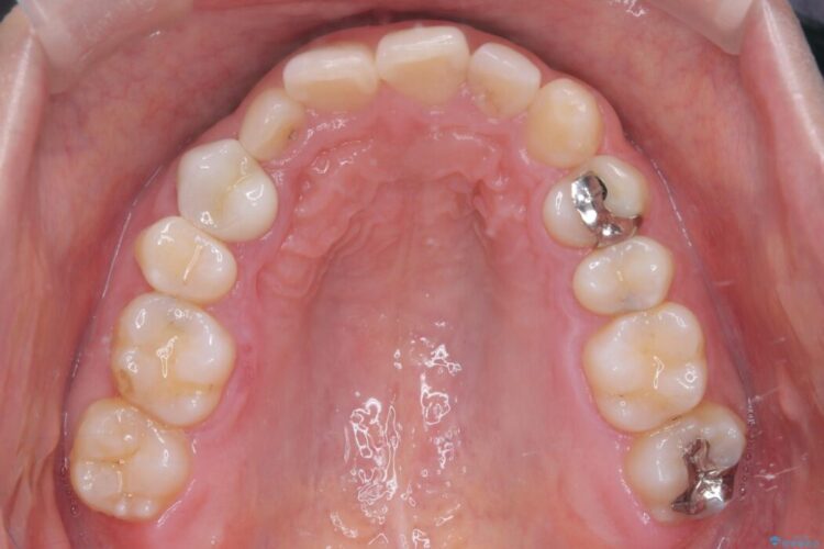 前歯のガタつきと反対咬合をインビザラインで短期矯正 治療前画像