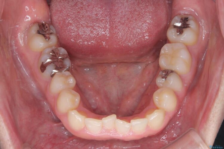 前歯のガタつきと反対咬合をインビザラインで短期矯正 治療前画像