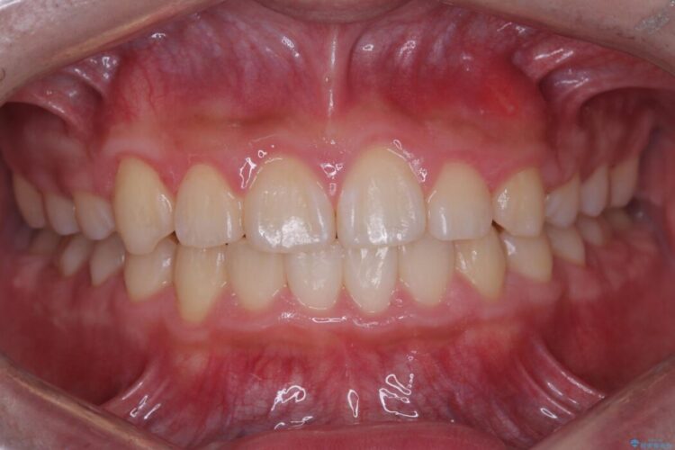 ガタつきとディープバイトの改善 アフター