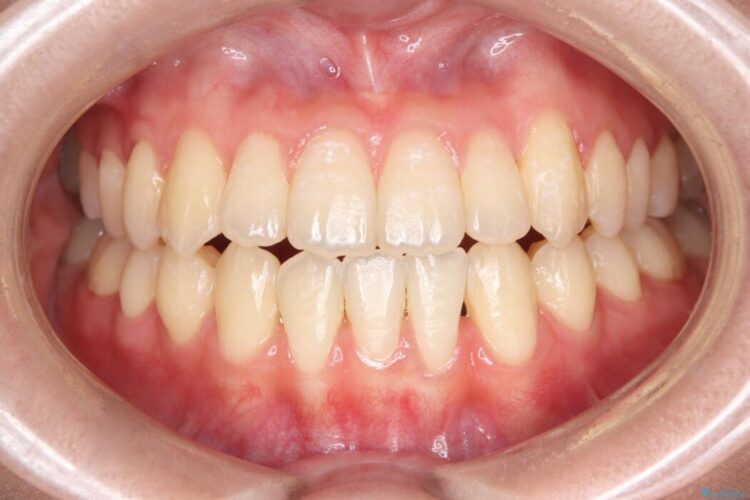 閉院による転院、インビザラインからワイヤー矯正への切り替え アフター