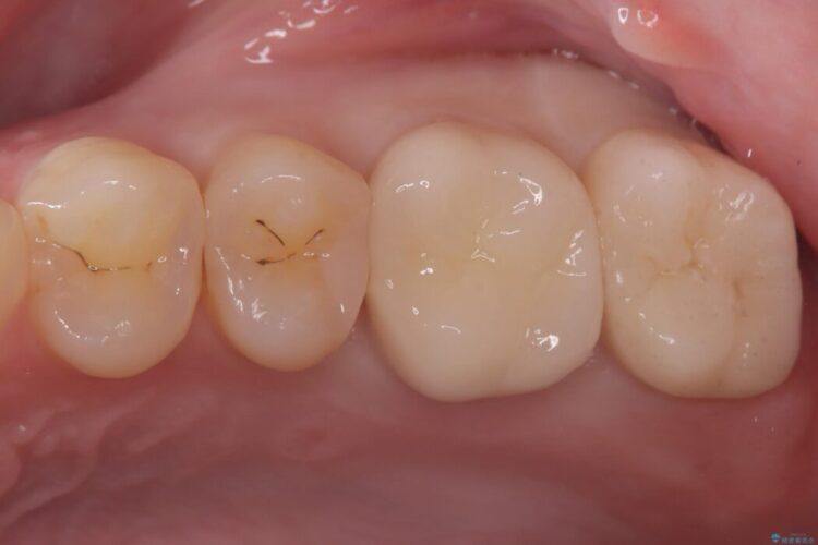 部分的断髄法（VPT）とセラミック修復 アフター