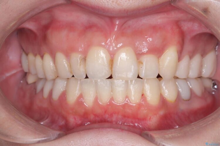 40代から始める矯正治療。八重歯が改善されすっきりとした歯並びに 治療後画像