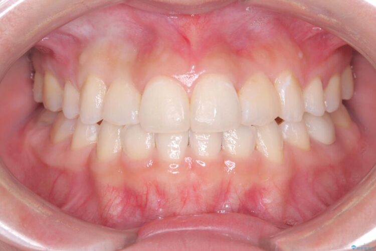 ワイヤー矯正とインビザラインの併用で重度のガタつきの改善 治療後画像