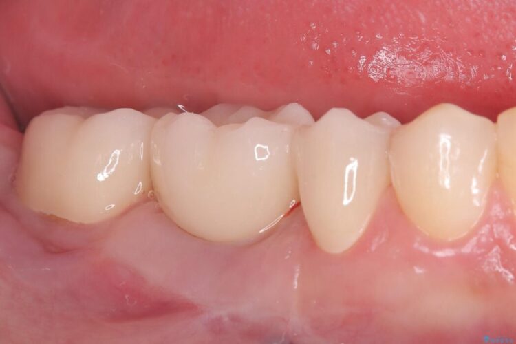歯肉移植後、ブリッジからインプラントへ 治療後画像