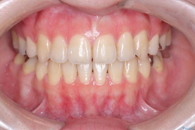 開咬・叢生・八重歯を抜歯矯正で改善 アフター