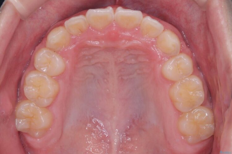 ガタつきとディープバイトの改善 治療後画像