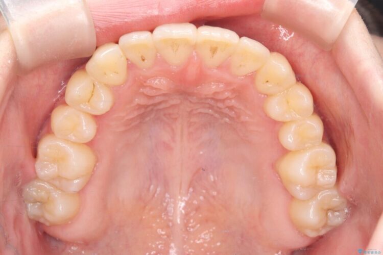 閉院による転院、インビザラインからワイヤー矯正への切り替え 治療後画像