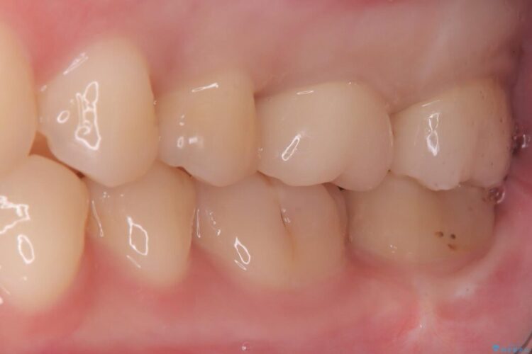 部分的断髄法（VPT）とセラミック修復 治療後画像