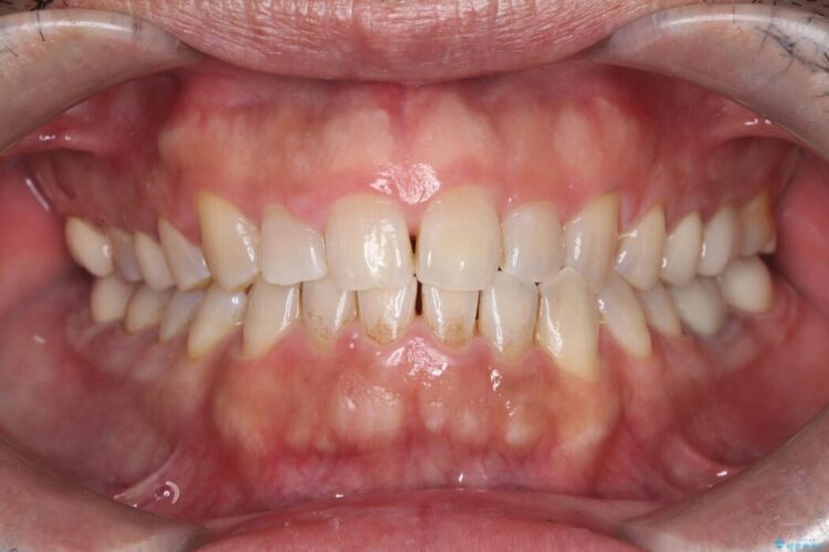 メタルフリー｜全ての銀歯をセラミックへ アフター