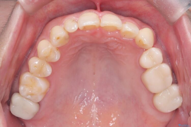 40代から始める矯正治療。八重歯が改善されすっきりとした歯並びに 治療後画像