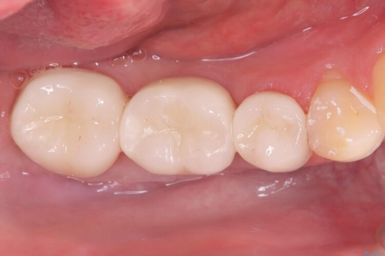歯肉移植後、ブリッジからインプラントへ 治療後画像