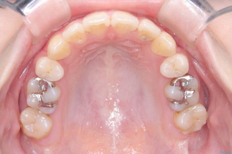 開咬・叢生・八重歯を抜歯矯正で改善 治療後画像