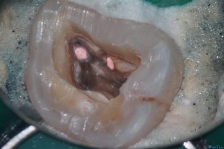 詰め物内部の虫歯治療、隠れた根管の発見 治療後画像