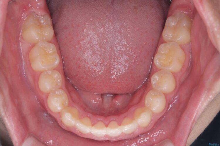 ガタつきとディープバイトの改善 治療後画像