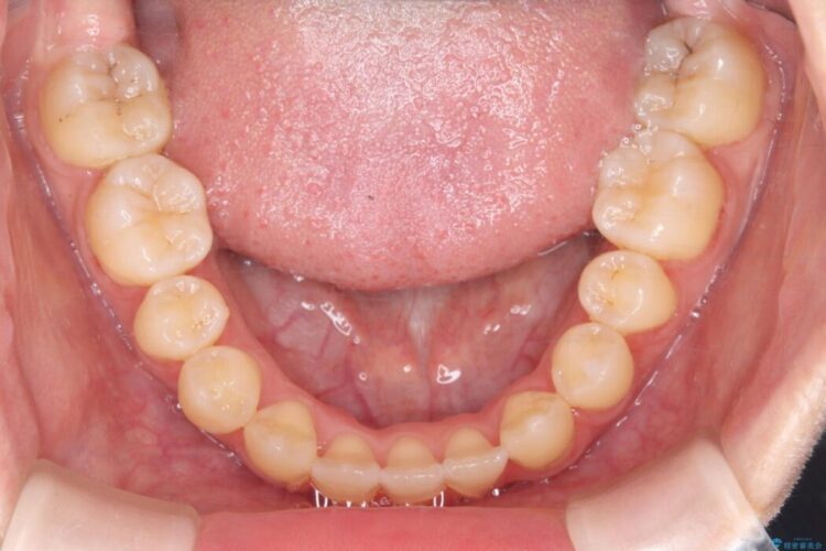 閉院による転院、インビザラインからワイヤー矯正への切り替え 治療後画像