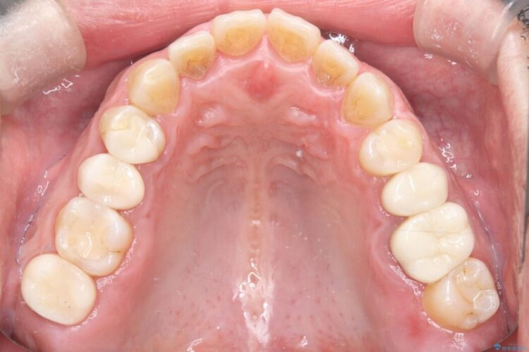 メタルフリー｜全ての銀歯をセラミックへ 治療後画像