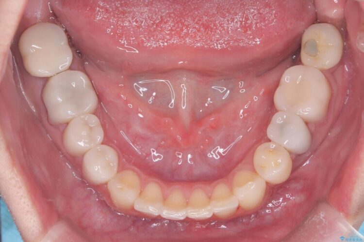 40代から始める矯正治療。八重歯が改善されすっきりとした歯並びに 治療後画像