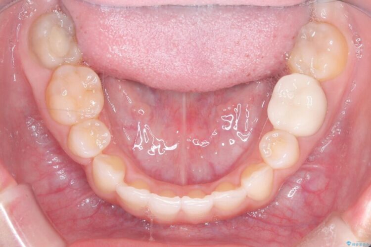 ワイヤー矯正とインビザラインの併用で重度のガタつきの改善 治療後画像