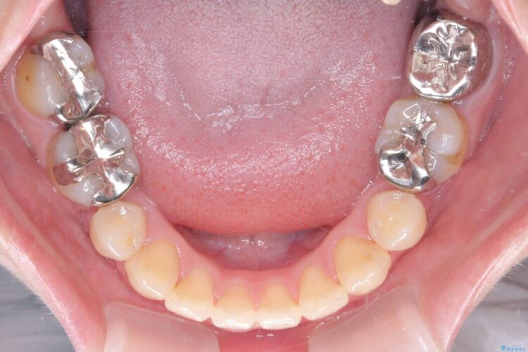 開咬・叢生・八重歯を抜歯矯正で改善 治療後画像