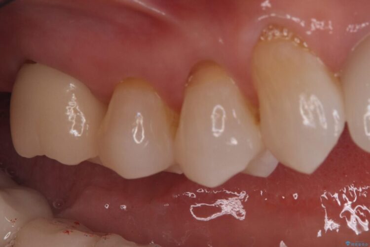 詰め物内部の虫歯治療、隠れた根管の発見 治療後画像