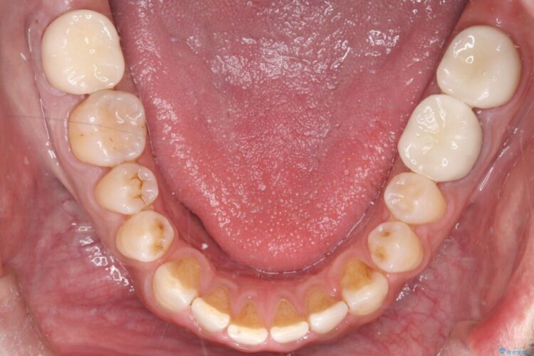 メタルフリー｜全ての銀歯をセラミックへ 治療後画像