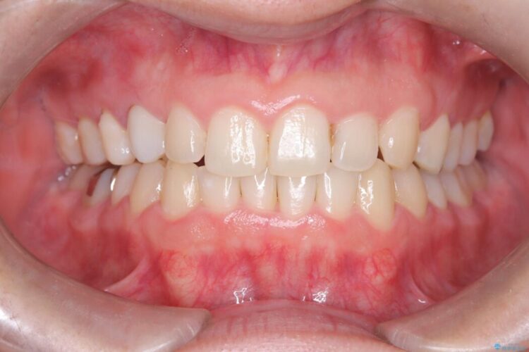 前歯のガタつきと反対咬合をインビザラインで短期矯正 治療後画像