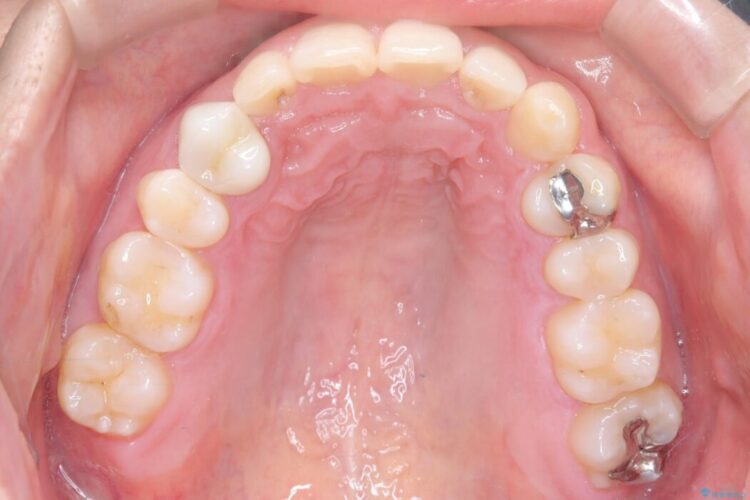 前歯のガタつきと反対咬合をインビザラインで短期矯正 治療後画像