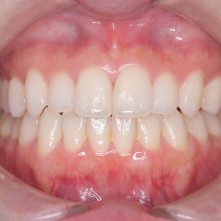 久しぶりのホワイトニング 治療前