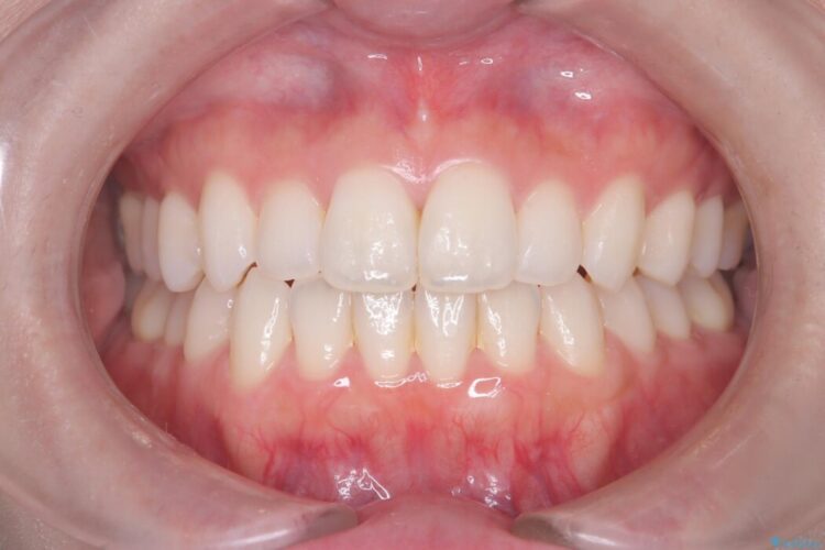 久しぶりのホワイトニング 治療前画像