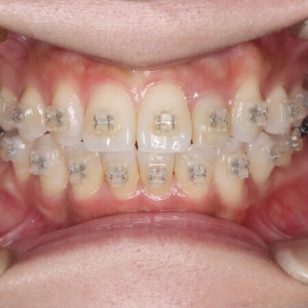 矯正治療中のクリーニング 治療前