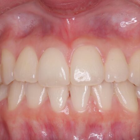 ホワイトニングで清潔感のある白い歯に 治療前