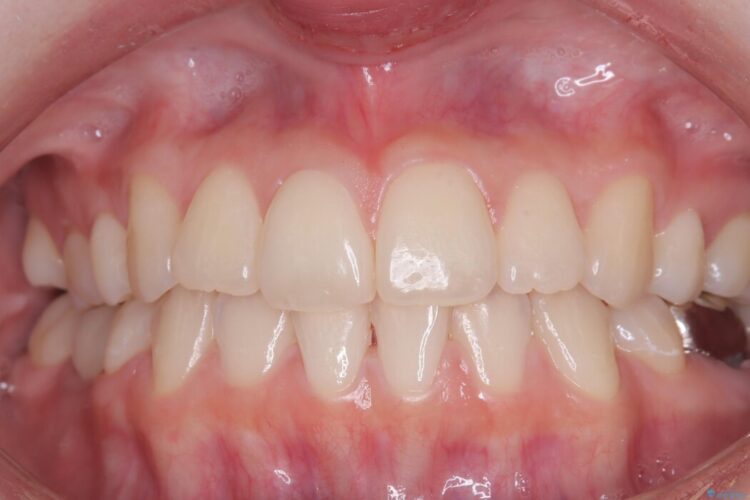 ホワイトニングで清潔感のある白い歯に 治療前画像