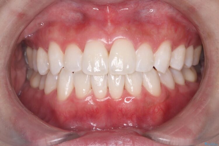 久しぶりのホワイトニング 治療後画像