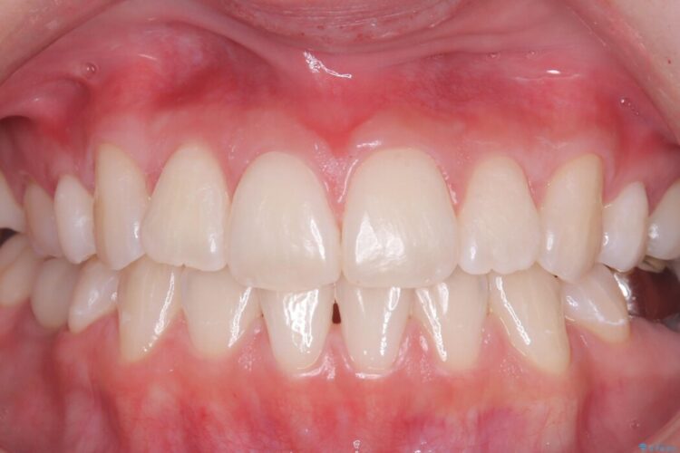 ホワイトニングで清潔感のある白い歯に 治療後画像