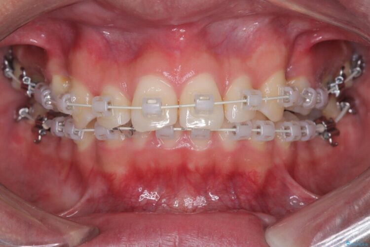 ガタつきや深い嚙み合わせ、気になるところを一気に解決 治療途中画像