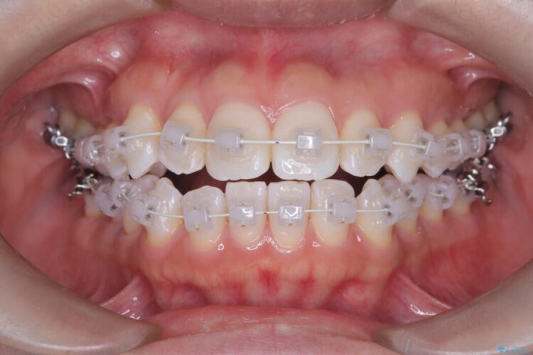非抜歯、短期間で。審美性の高い装置で目立ちにくい矯正治療 治療途中画像