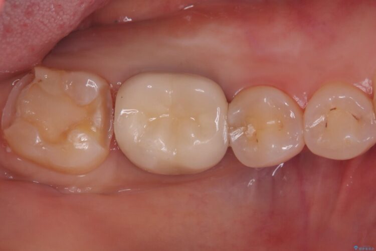 奥歯の奥側にできてしまった虫歯 治療途中画像