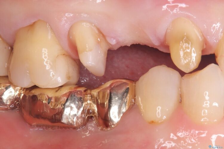 ブリッジの歯の一部が欠けてしまった 治療途中画像