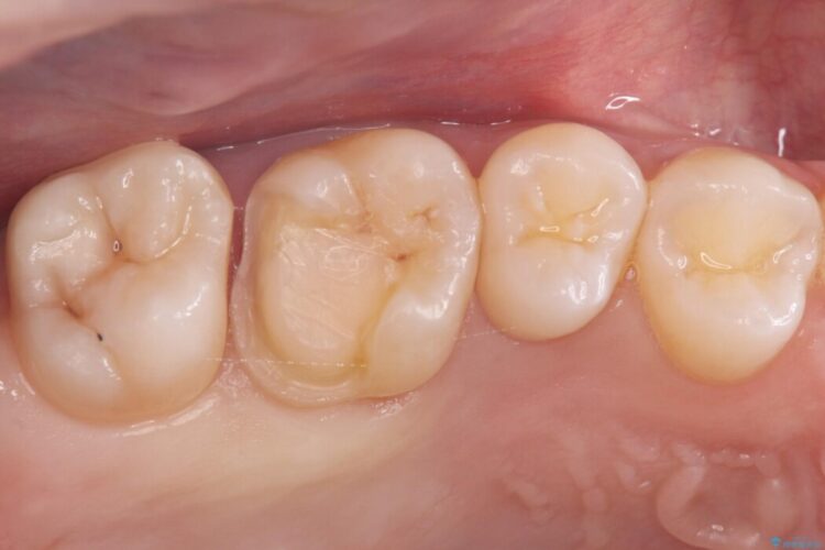 欠けた歯の修復 治療途中画像