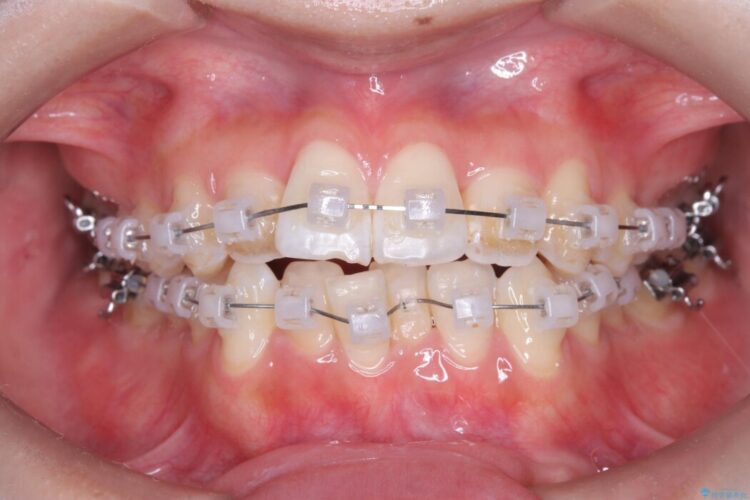 1年で変わる！非抜歯ワイヤー矯正でガタつきの改善 治療途中画像
