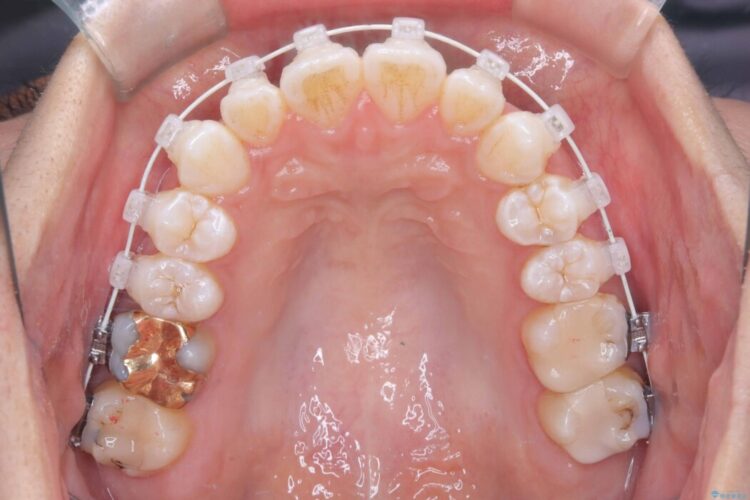 非抜歯、短期間で。審美性の高い装置で目立ちにくい矯正治療 治療途中画像