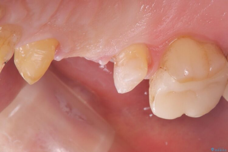 ブリッジの歯の一部が欠けてしまった 治療途中画像