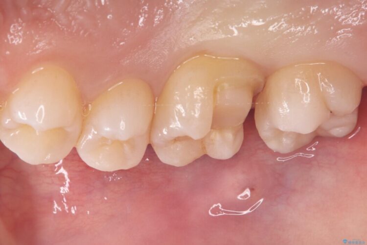 欠けた歯の修復 治療途中画像