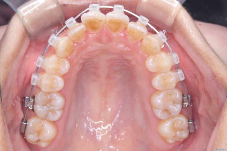 1年で変わる！非抜歯ワイヤー矯正でガタつきの改善 治療途中画像