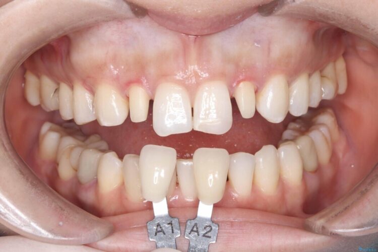 矯正治療後、セラミックで審美修復 治療途中画像