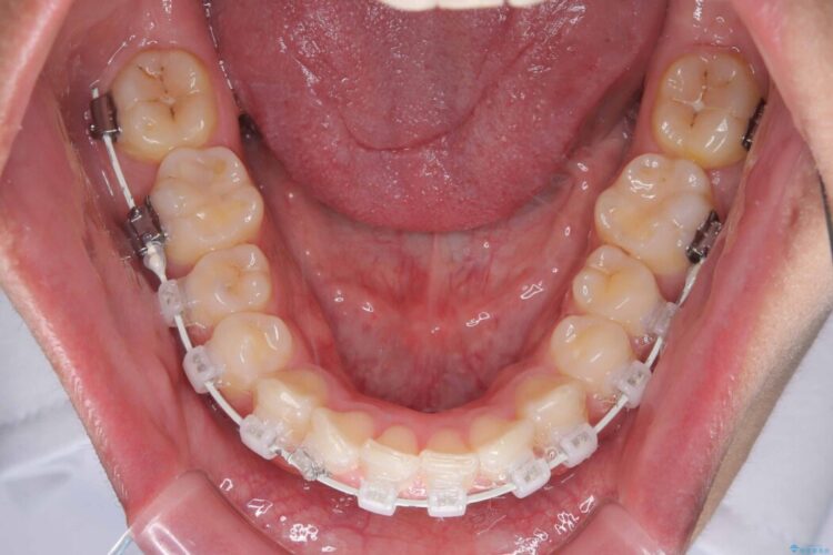 ガタつきや深い嚙み合わせ、気になるところを一気に解決 治療途中画像