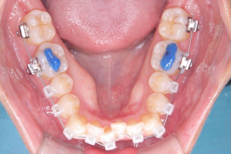 1年で変わる！非抜歯ワイヤー矯正でガタつきの改善 治療途中画像
