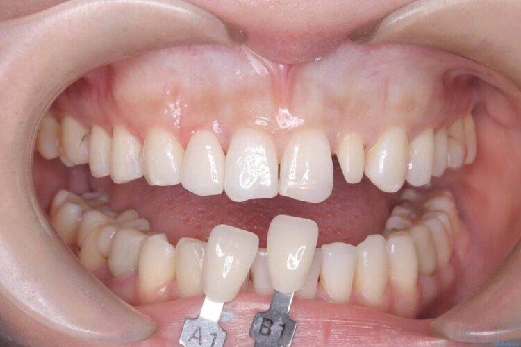 矯正治療後、セラミックで審美修復 治療途中画像